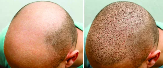 Implante Cabelo Goiânia