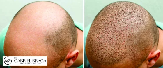 Goiânia - Transplante Capilar
