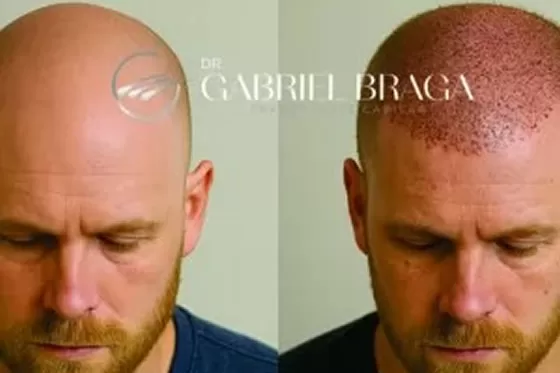 Transplante Capilar com Alta Densidade em Goiânia, Goias