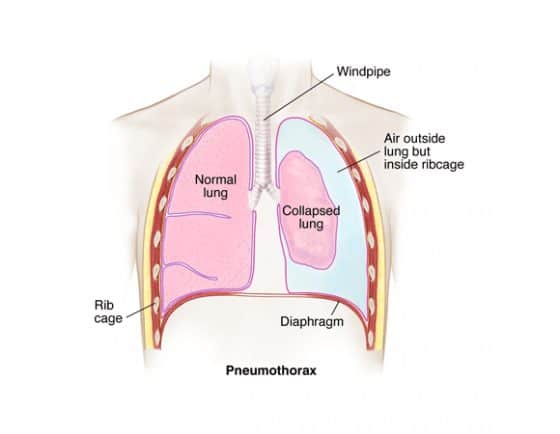 Pneumothorax