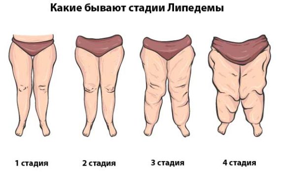 Стадии Липедемы