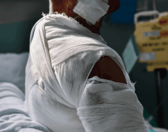 Burn injury victim with severe arm and shoulder burns wrapped in bandages in a Texas hospital.