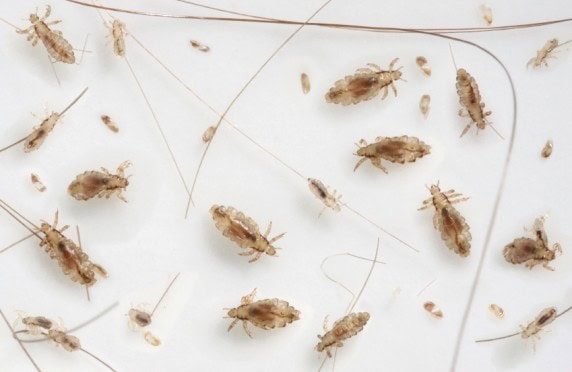 head_lice_nits_-572×372