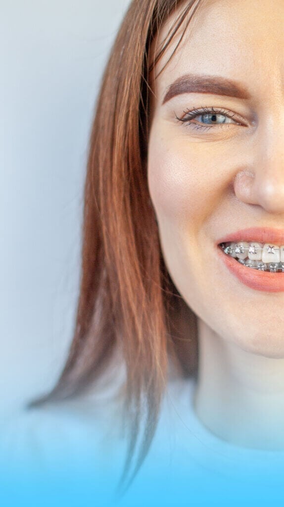aparat dentar adulti pret