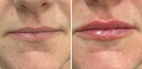 Aumento de labios clinica fontana 3