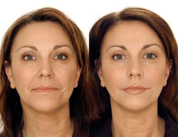 Mesoterapia facial con redensificación en Clínica Fontana Valencia