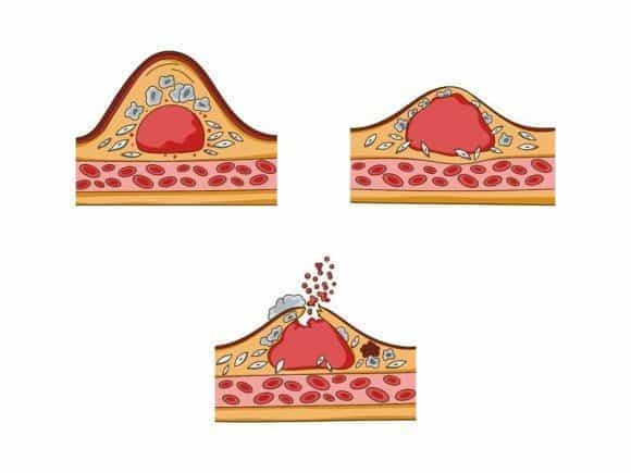 Angina Pectoris - What Is Angina and How Do We Deal With It?