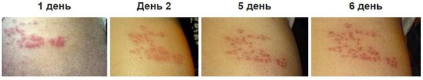 Разница между Корью и Опоясывающим лишаем 5 Стадии Опоясывающего лишая