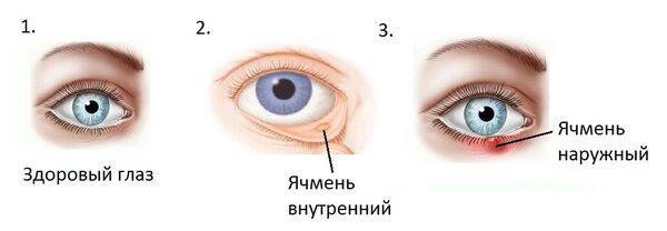 Разница между Блефаритом и Ячменем 3 Виды Ячменя на глазу