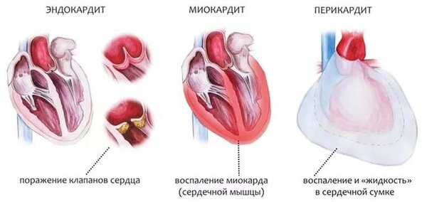 Разница между Миокардитом и Перикардитом 1 Миокардит, Перикардит и Эндокардит