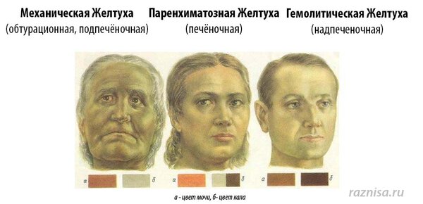 Желтуха