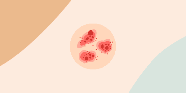 eczema penis