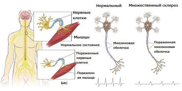 Разница между БАС и БДН 1 Боковой Амиотрофический Склероз