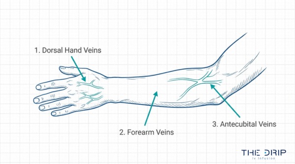 Best vein locations for IV insertion diagram showing dorsal hand veins, forearm veins, and antecubital veins