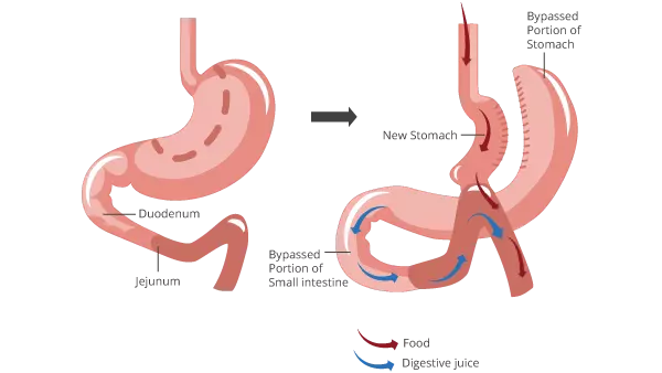 Mini Gastric Bypass Surgery Mini Gastric Bypass Surgery
