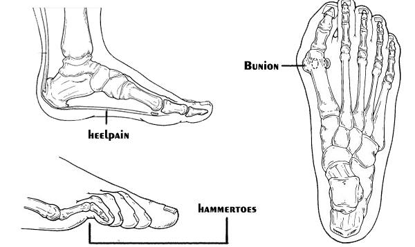 Bunion Infinity Foot and Ankle -