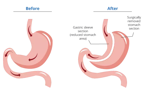 Gastric Sleeve Surgery Gastric Sleeve Surgery