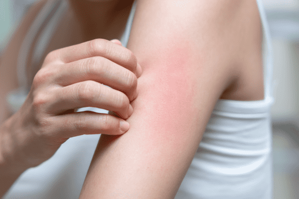 ekcema_szteroidos_kremek_mik_a_veszelyek