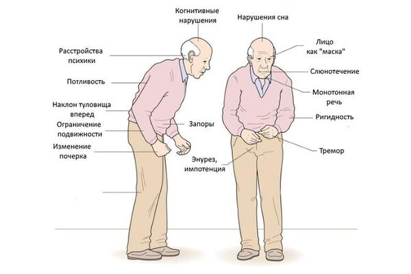 Разница между эссенциальным тремором и болезнью Паркинсона 3 Болезнь Паркинсона