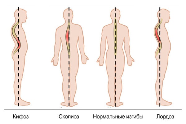 Разница между Лордозом, Кифозом и Сколиозом 1 Лордоз, Кифоз и Сколиоз