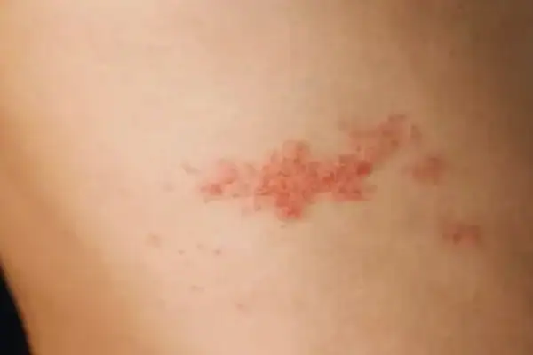gürtelrose impfung
