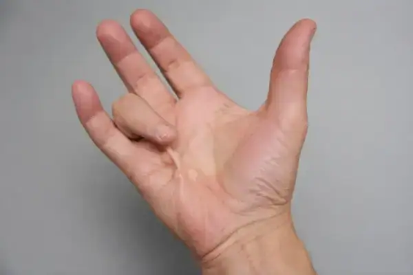 Dupuytren'-contracture