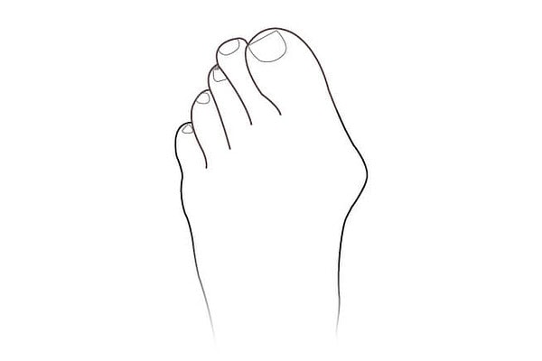 Bunions
