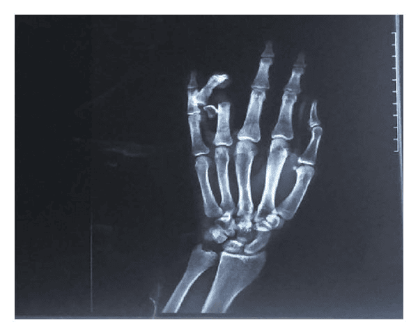 Contusions and Crush Injuries