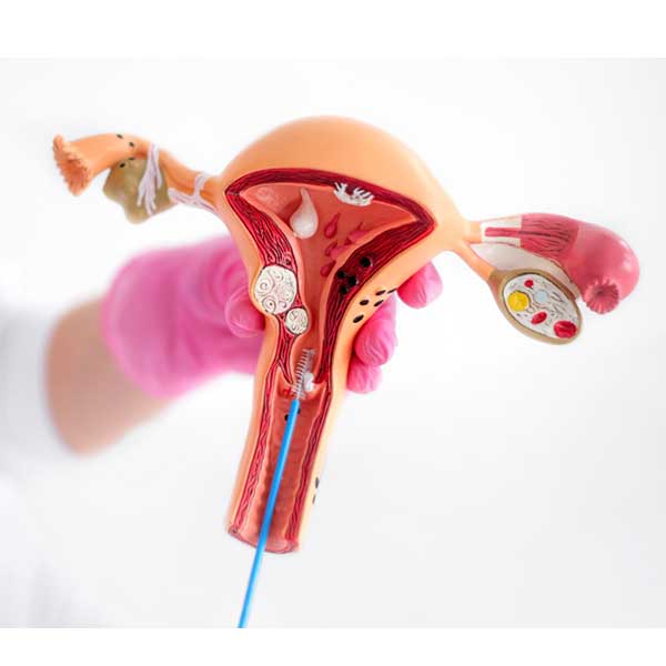 דימום לאחר מנופאוזה / ביופסיה של רירית הרחם