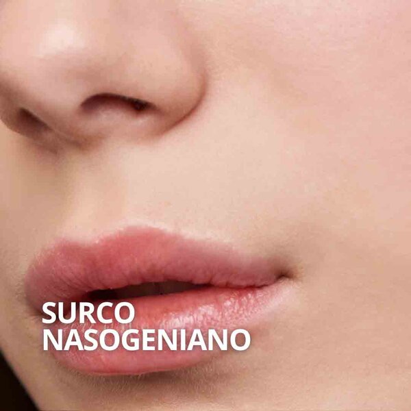 relleno surco nasogeniano Sevilla