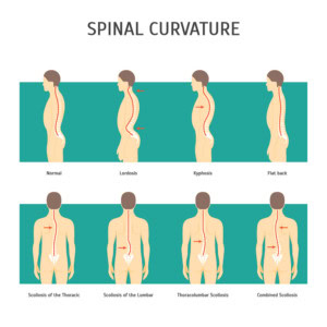 Curvature of the spine infographic