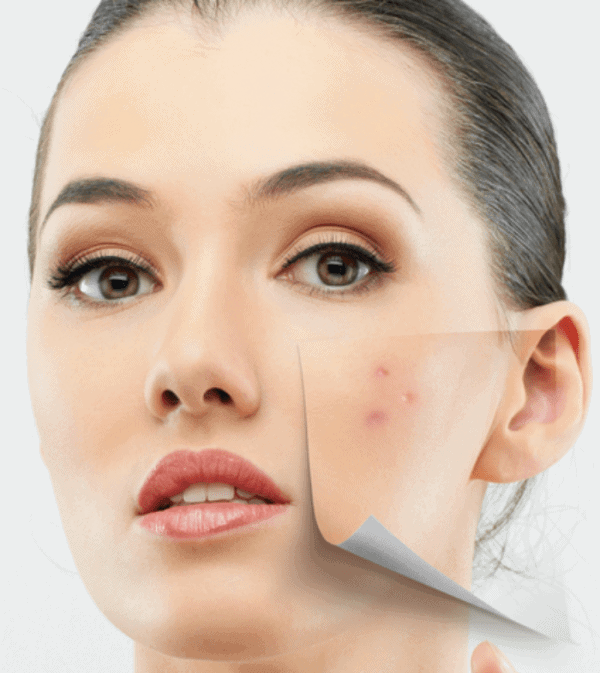 Choose your chemical peel – guide Choose your chemical peel – guide