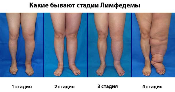 Разница между Липедемой и Лимфедемой 2 Стадии-Лимфедемы