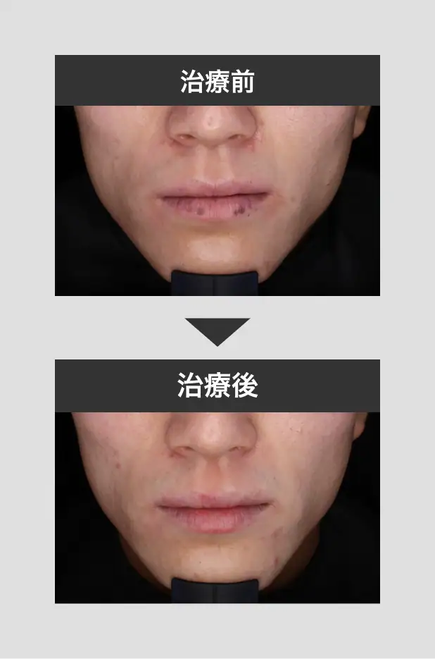 唇のシミ治療