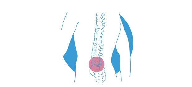 Artículo Hernia Discal - Madrid