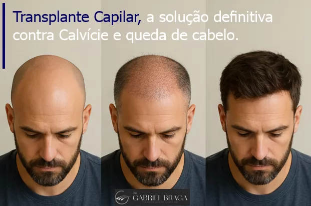 Hair Transplant brazil