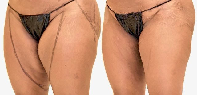 Thigh liposuction before and after, actual patient of Dr. Long