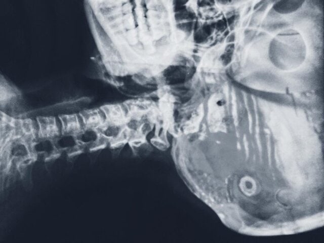Average Car Accident Settlements for Neck and Back Injuries (2026 Florida Update)