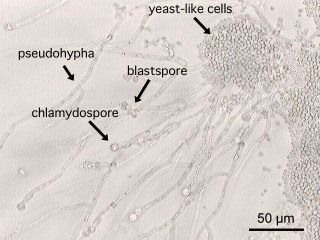 Bacterial Biofilm Infections