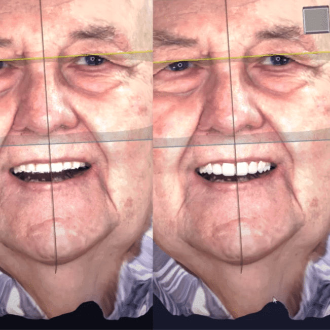 Smile Design avec RAYFace