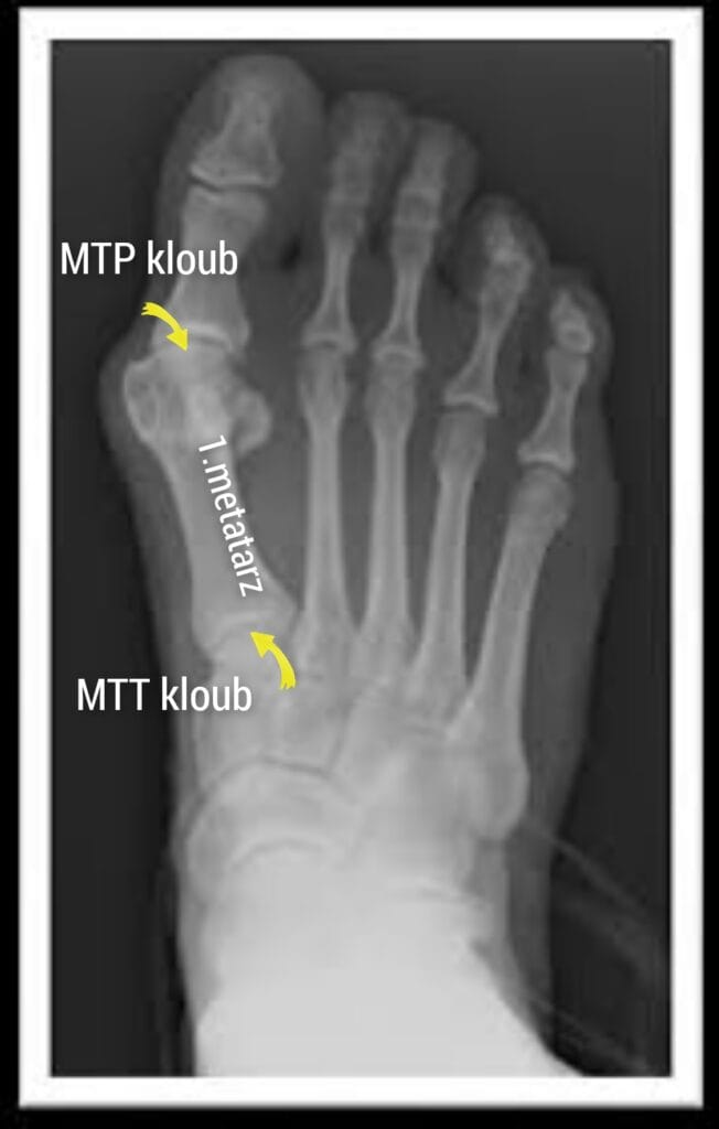 Hallux valgus vbočený palec