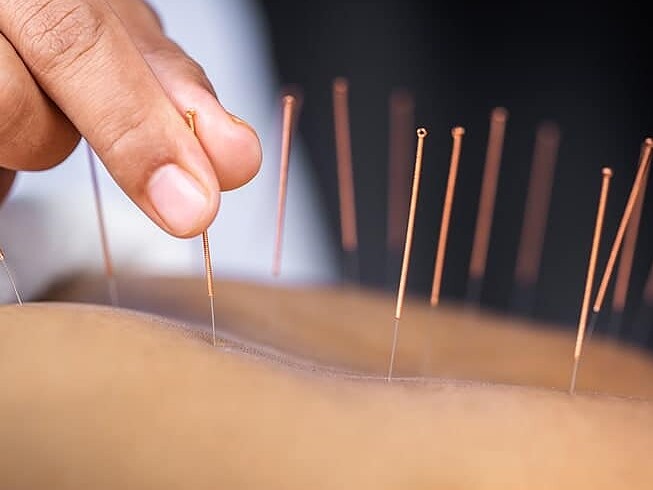 Acupuntura2 1