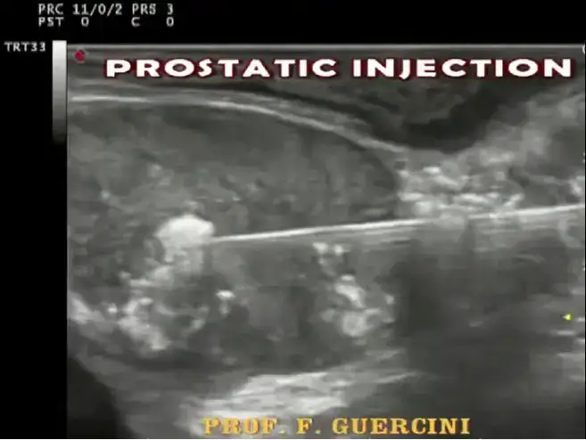 infiltrazioni prostatiche