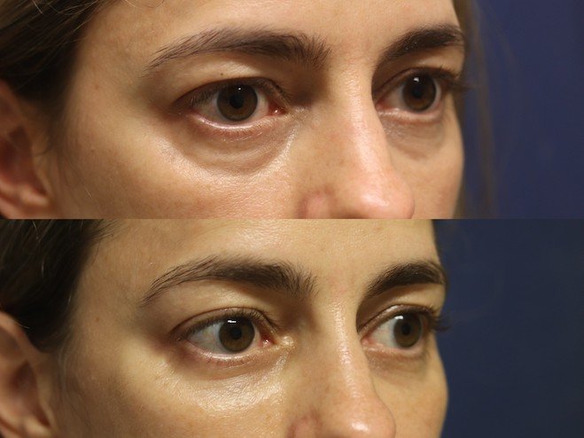 tratamiento de ojeras en valencia