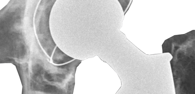 X-ray of total hip replacement prosthesis after surgery