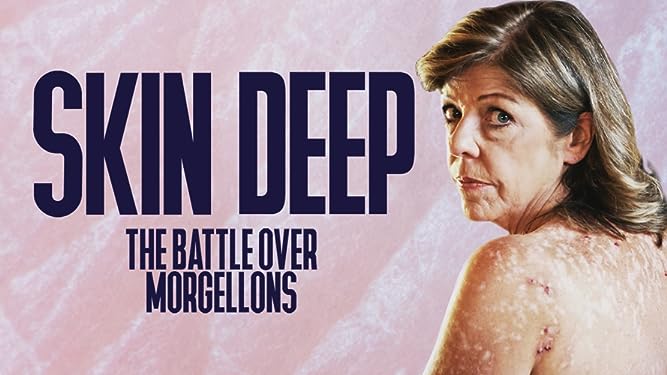 Skin Deep: The Battle Over Morgellons