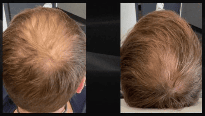 PRP (Platelet-Rich Plasma) Hair Treatment in Regina to Increase Hair Thickness and Density