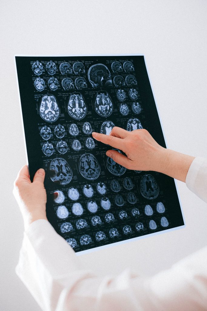 Close-up of a person holding and pointing at a detailed brain scan on a black-and-white medical imaging sheet, displaying multiple cross-sectional views of the brain.