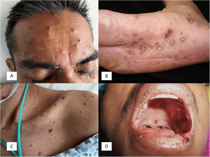 Symptoms of Histoplasmosis in Humans