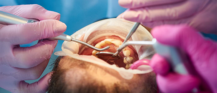 Root canal treatment